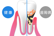 健康な歯と歯周病の歯